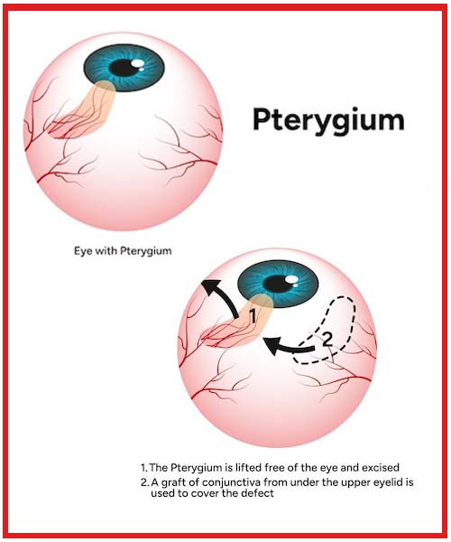 pterygium-surgery